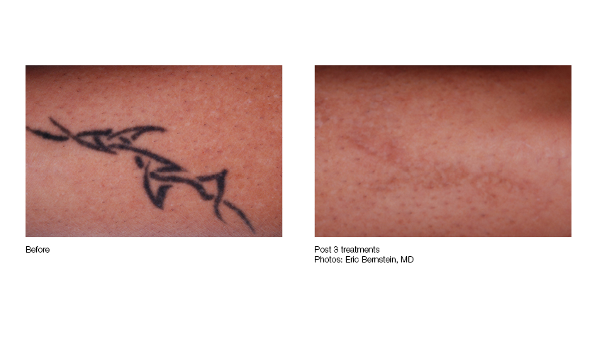 Laser Tattoo Removal Pittsburgh