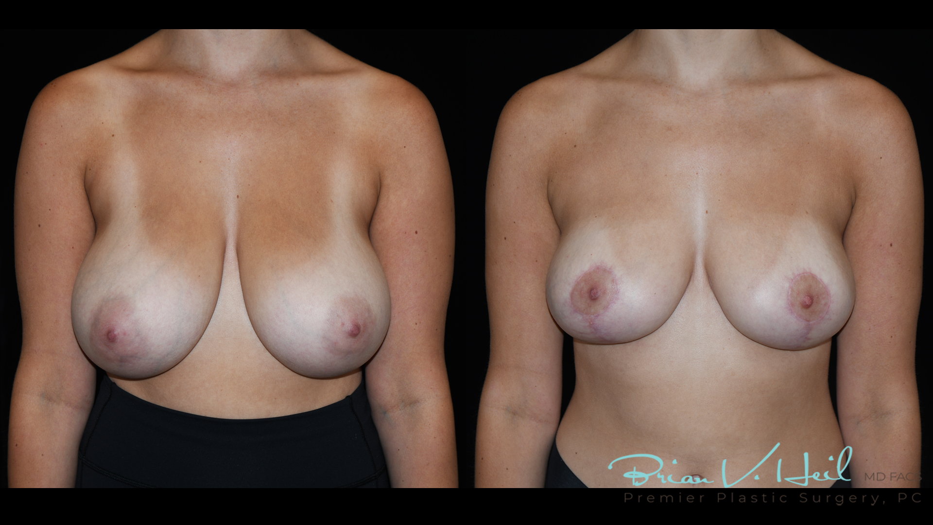 Breast Reduction in Pittsburgh, PA