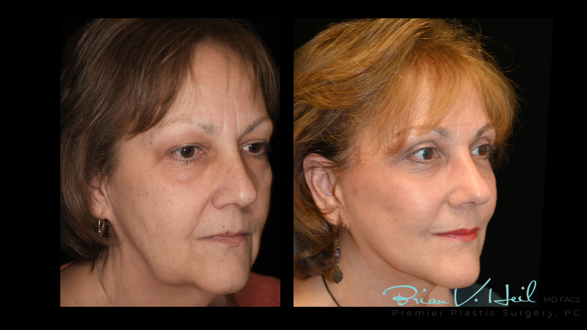 Facelift Surgery in Pittsburgh, PA