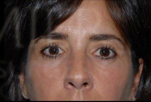 Blepharoplasty Before and After | Premier Plastic Surgery