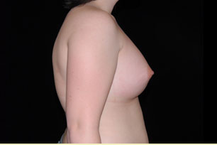 Breast Augmentation Before and After | Premier Plastic Surgery