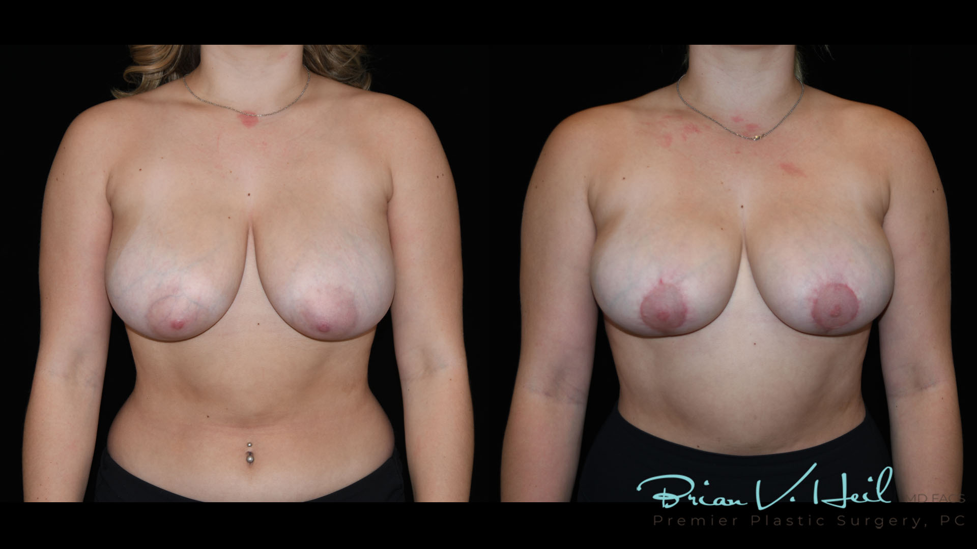 Breast Lift Before and After | Premier Plastic Surgery