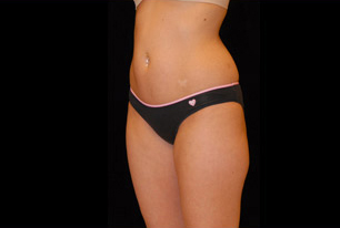 Liposuction Before and After | Premier Plastic Surgery