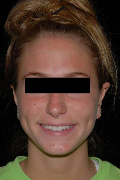 Otoplasty Before and After | Premier Plastic Surgery